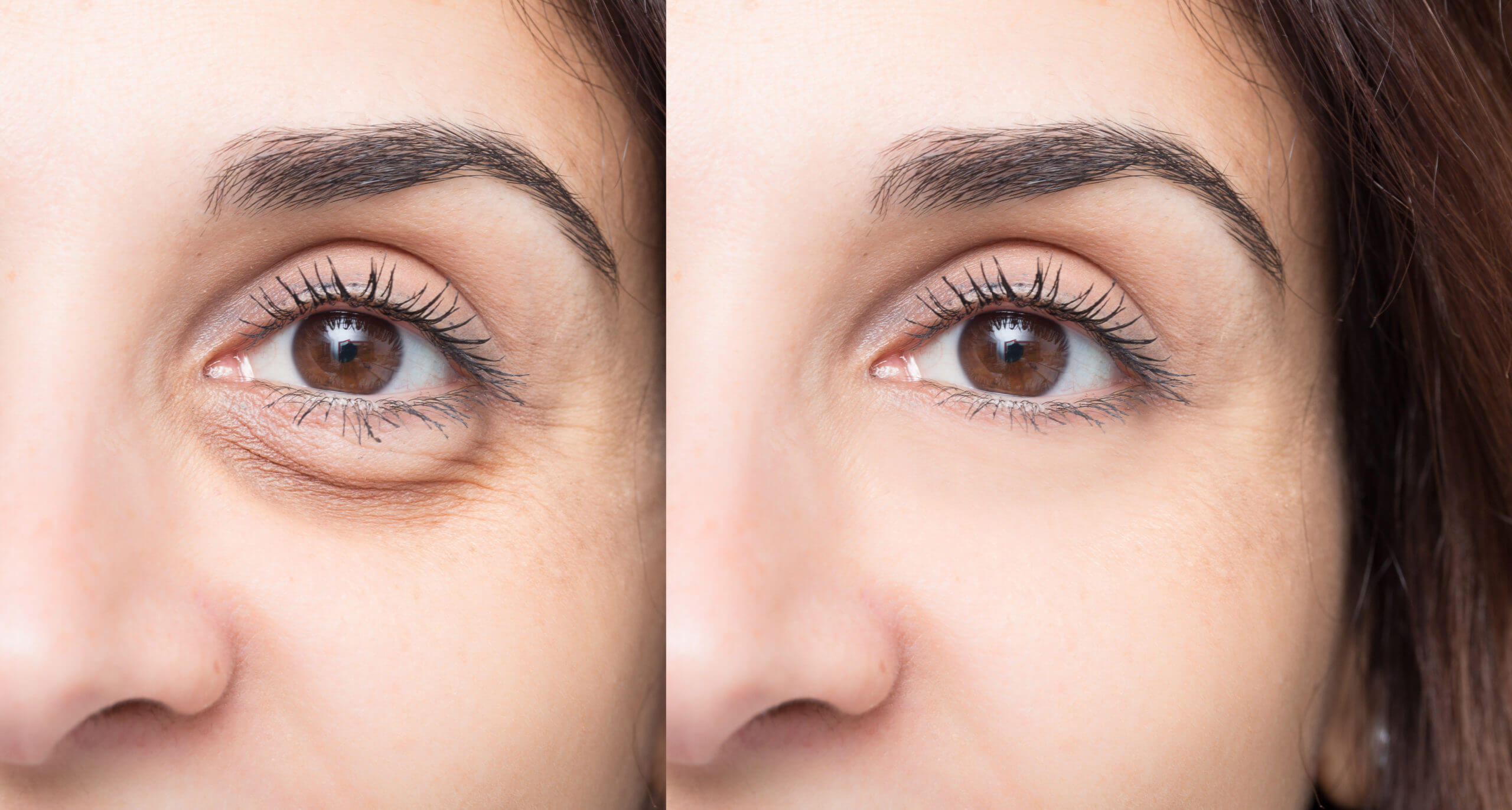 Tear Trough / Under eye fillers treatment in Norco CA by Le Meilleur Beauty and Wellness
