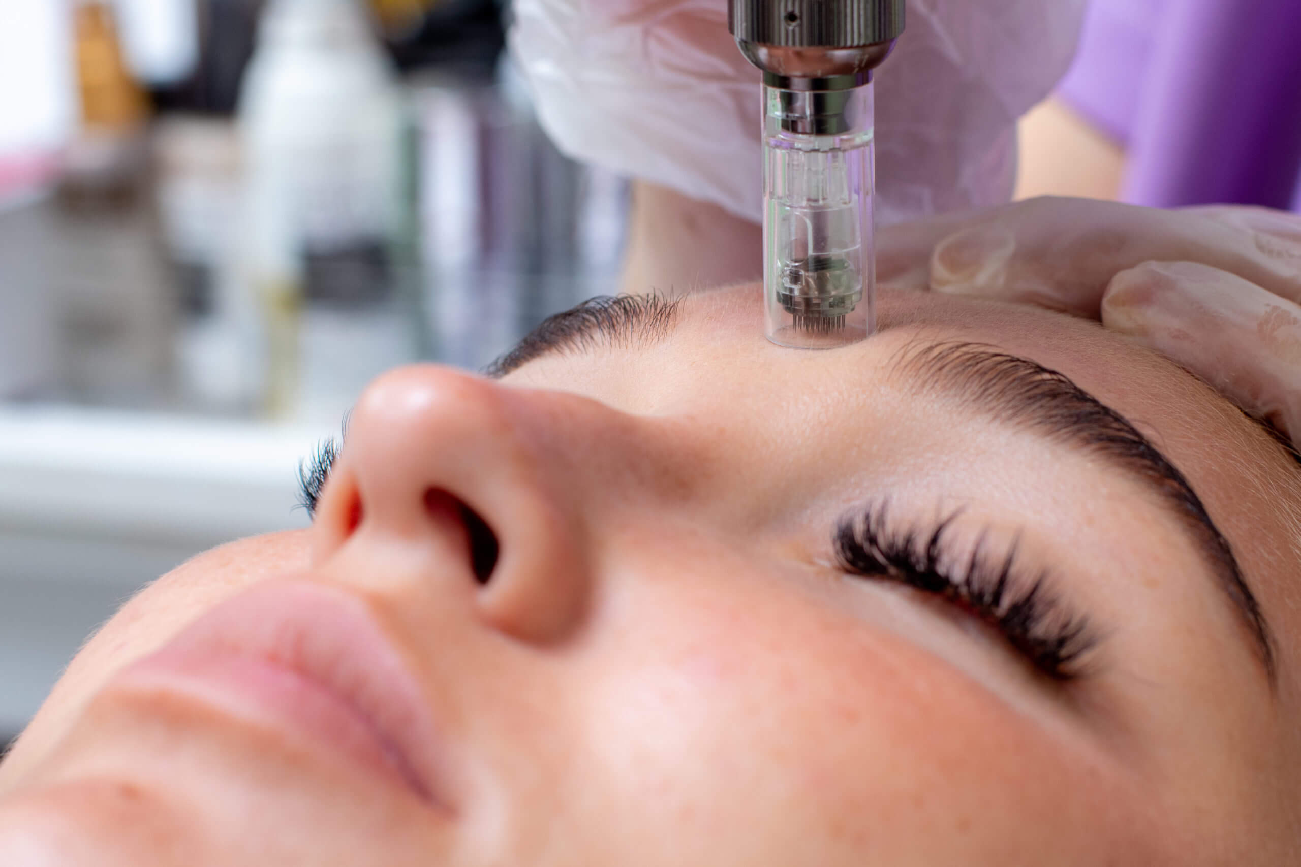 Microneedling in Norco CA by Le Meilleur Beauty and Wellness