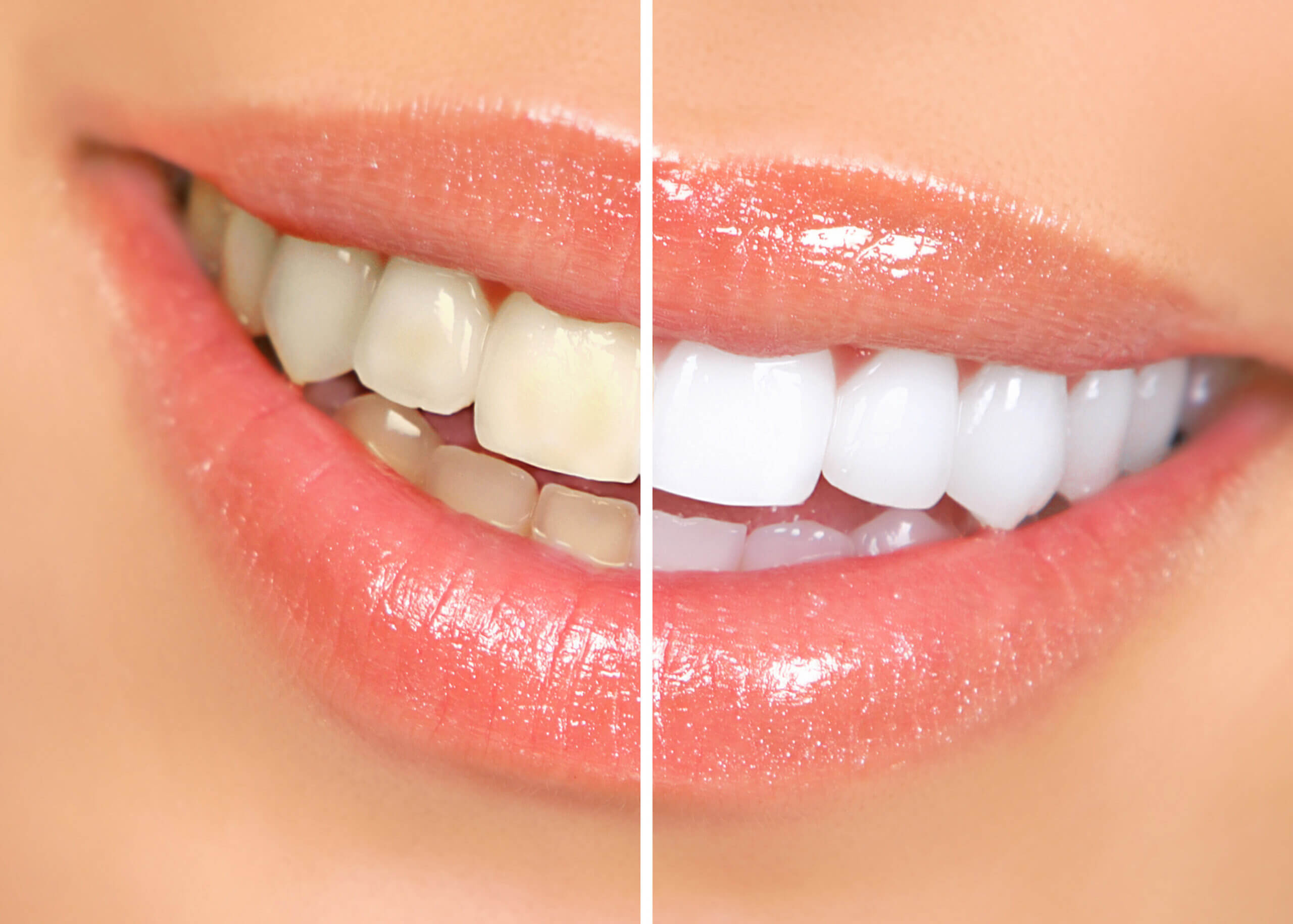Teeth Whitening in Norco CA by Le Meilleur Beauty and Wellness
