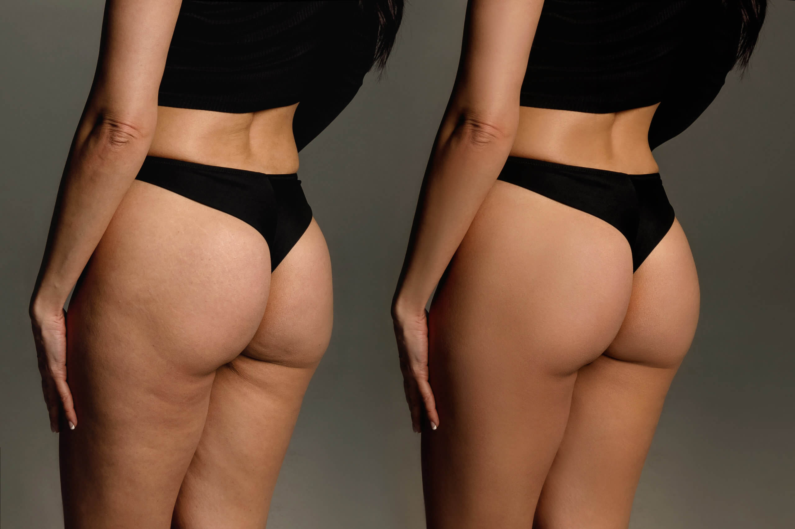 Is Vacuum Therapy Good For Buttock Augmentation