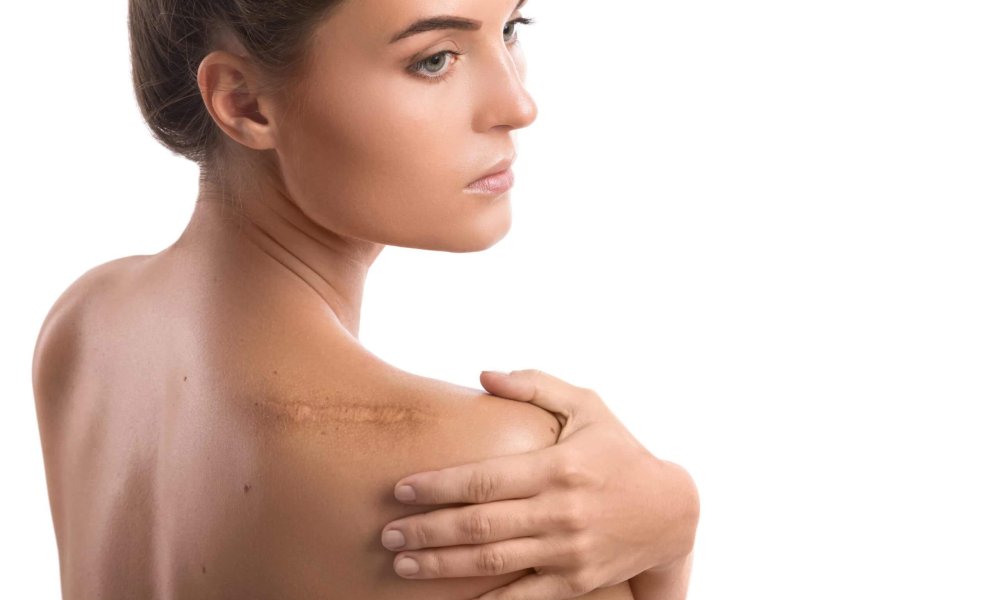 What is the Most Effective Treatment for Keloids